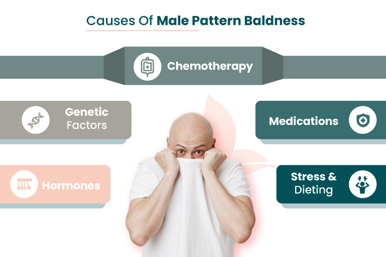 causes-of-male-pattern-baldness